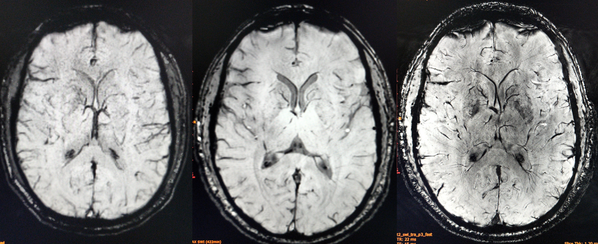 Three MRI scans of the same brain demonstrate the difference between 1.5 Tesla (left), 3 Tesla (center) and 7 Tesla (right) MRI. Credit: Carle Health