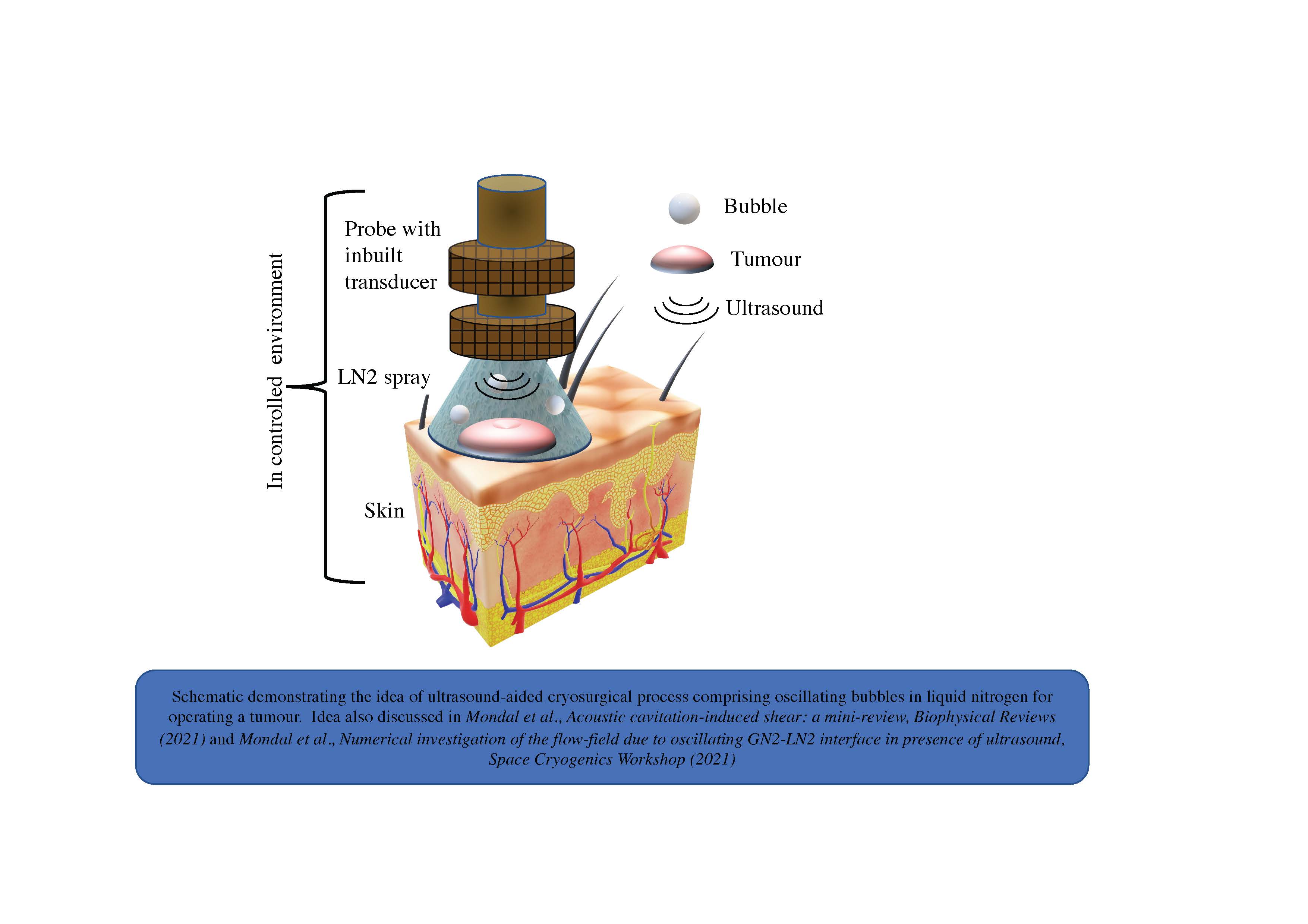 Schematic demonstrating the idea of an ultrasound-aided cryosurgical process comprising oscillating bubbles in liquid nitrogen for operating on a tumor. This idea was also discussed in Mondal et al., "Acoustic Cavitation-induced Shear: A Mini- Review," Biophysical Reviews (2021) and Mondal et al., "Numerical Investigation of the Flow-field Due to Oscillating GN2-LN2 Interface in Presence of Ultrasound," Space Cryogenics Workshop (2021). Credit: Indian Institute of Technology Kharagpur, India